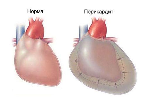 左側急性心包炎和胸痛