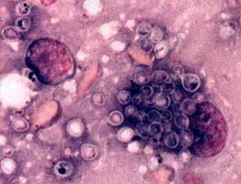 組織胞漿菌 - 組織胞漿菌病的病原體