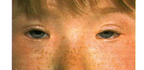眼睑下垂综合征。双侧手术治疗眼睑下垂、眼角膜扩大和眼睑下垂