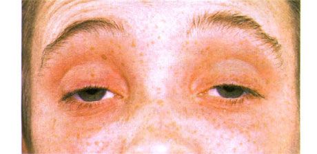 外眼肌麻痹。双侧眼睑下垂。患者通过抬起眉毛来睁开眼睛。