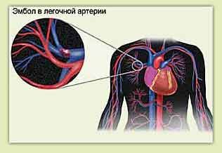 肺動脈栓塞和左側胸痛